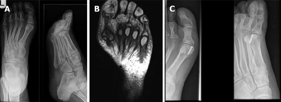 sesamoid bone fracture