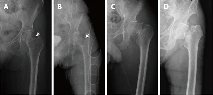 femoral neck fracture