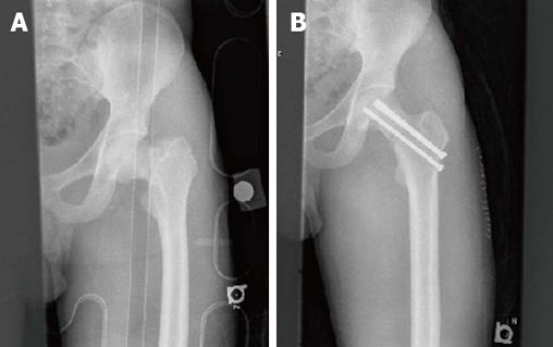 femoral neck fracture fixation