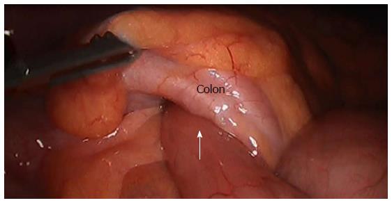 Ileocolic Intussusception Caused By A Lipoma In An Adult