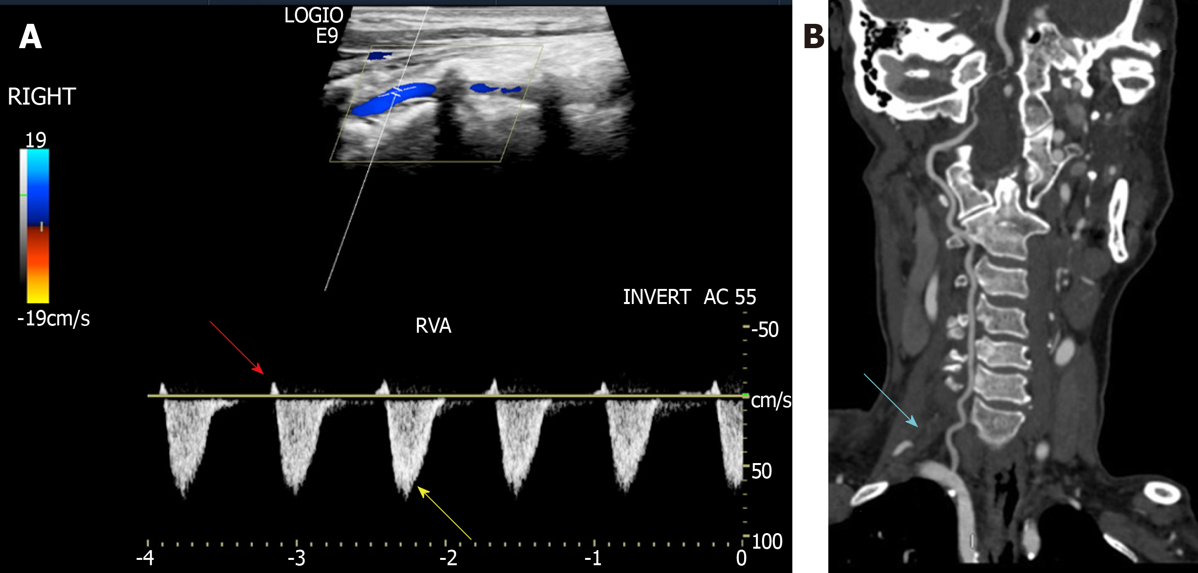 Carotid Artery Stenosis Ultrasound