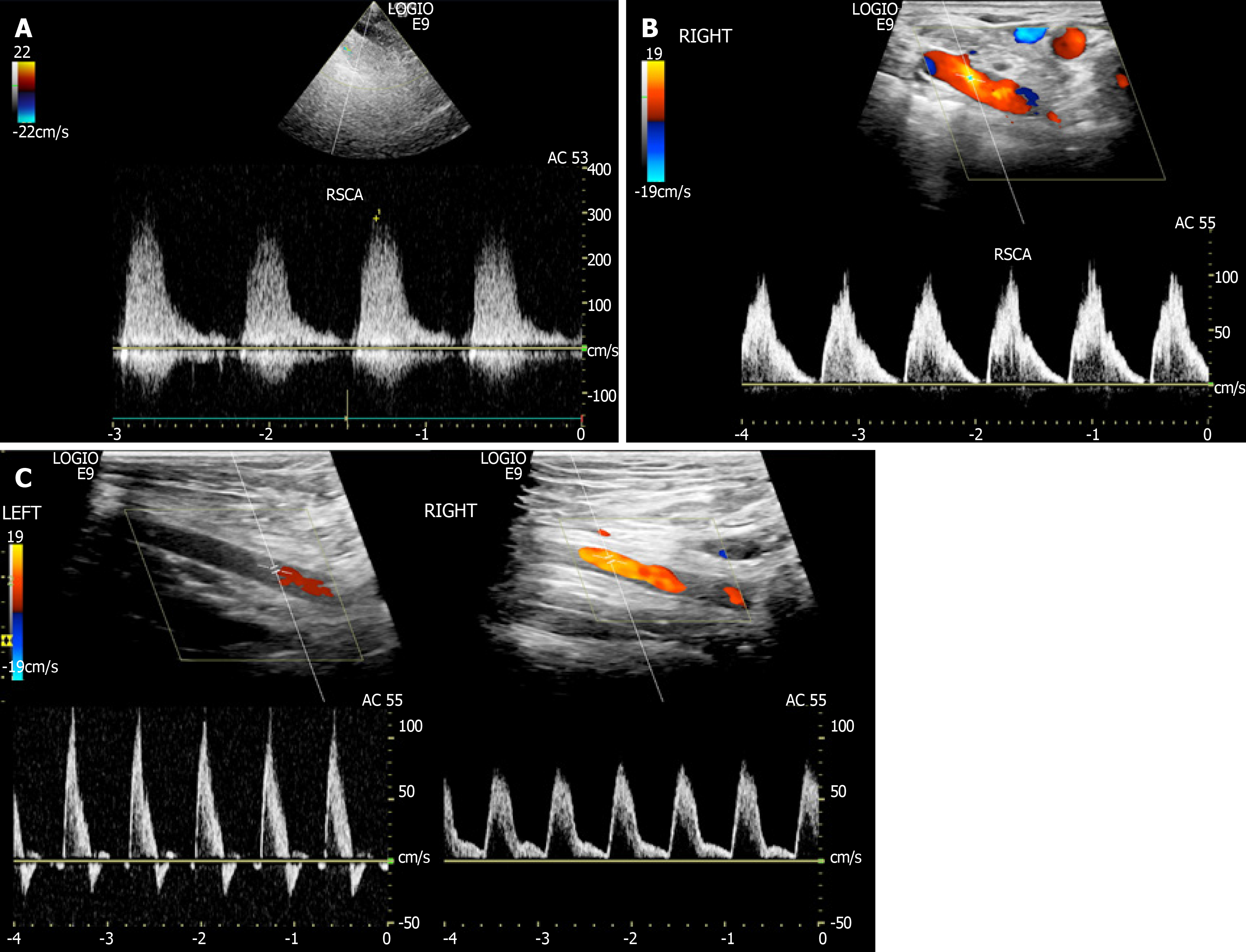 Carotid Ultrasound Velocity Chart