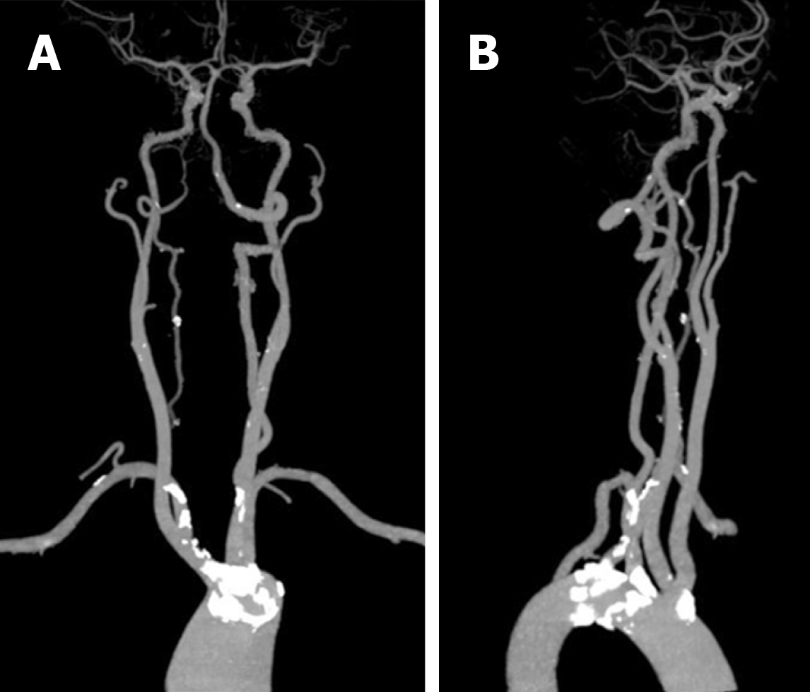 Bilateral Common Carotid Artery Common Trunk With Aberrant Right Subclavian Artery Combined With