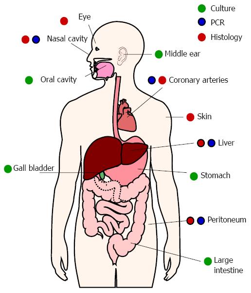 Beyond the stomach An updated view of Helicobacter pylori