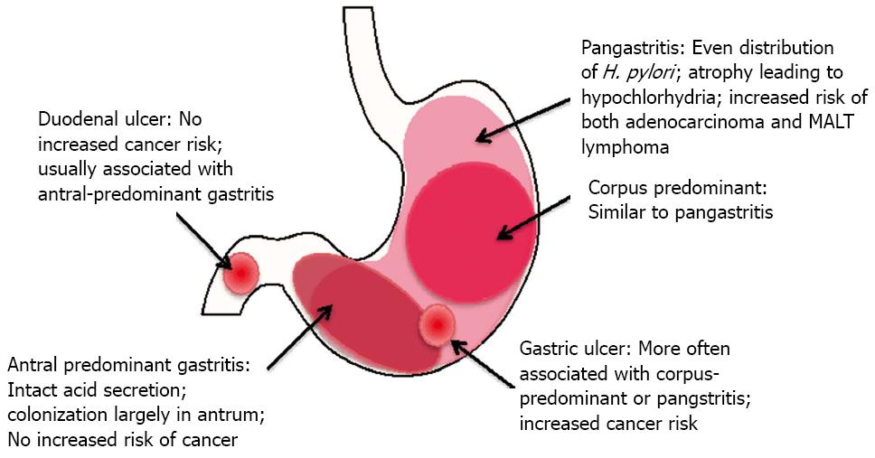 Beyond the stomach An updated view of Helicobacter pylori