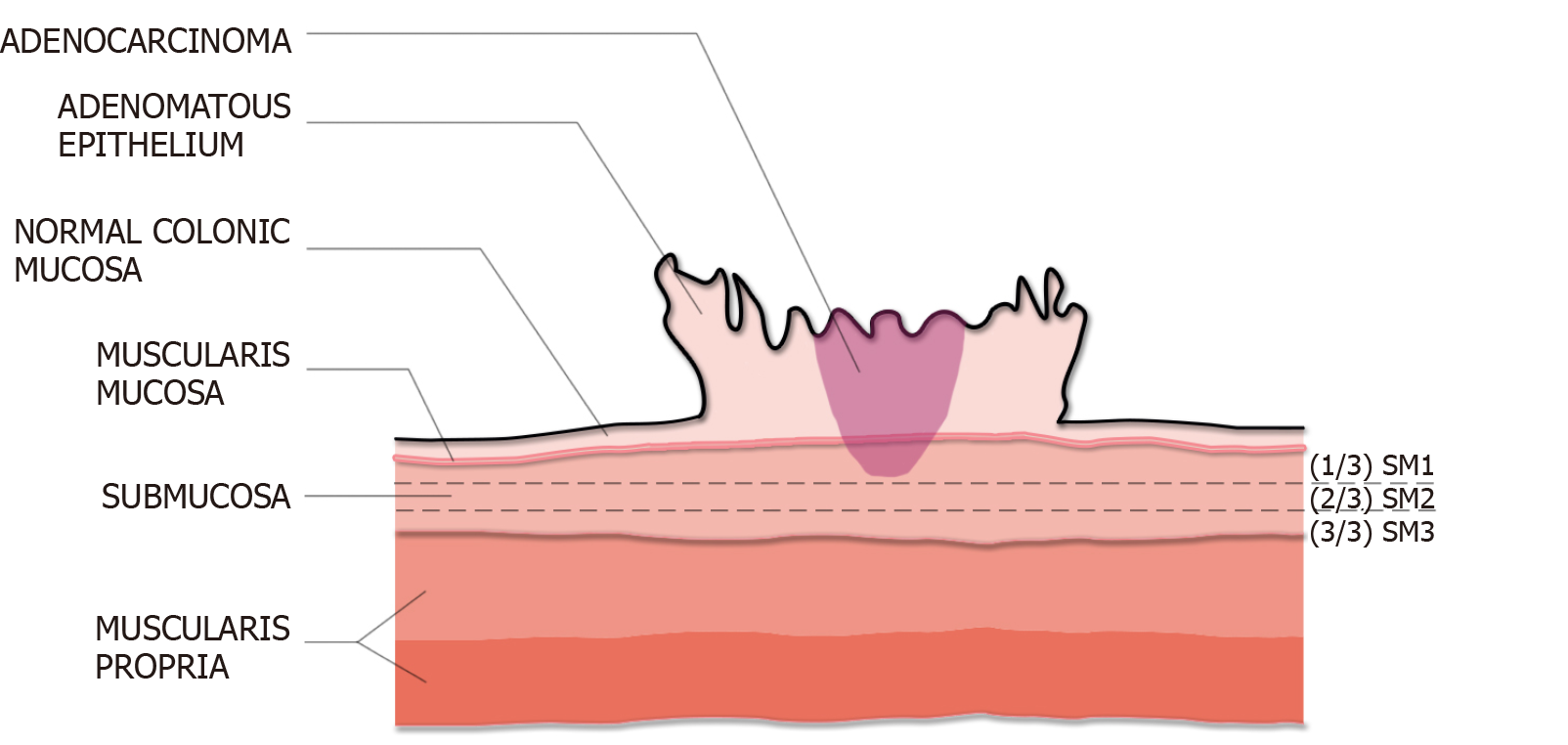 Endoscopic Management Of Colorectal Polyps From Benign To Malignant Polyps