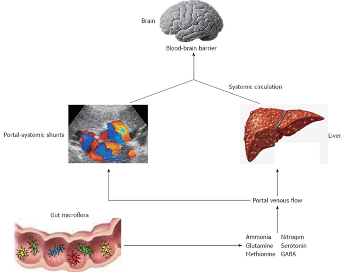 hepatic-encephalopathy-definition-grading-clinical-features