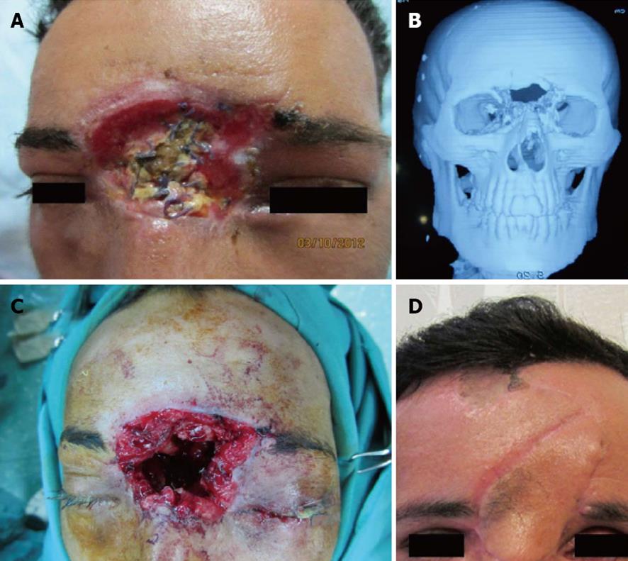 Management of missile injuries to the maxillofacial region 