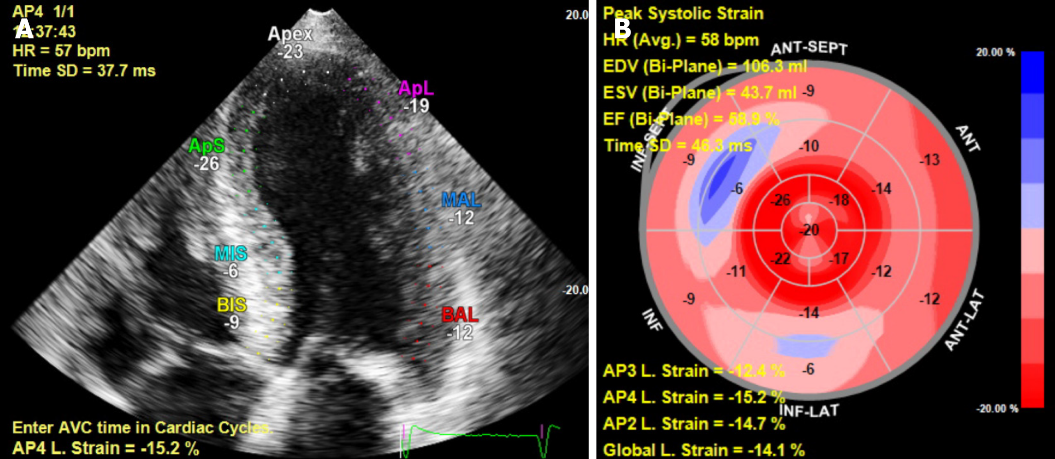 Relative apical sparing of longitudinal strain using two-dimensional  speckle-tracking echocardiography is both sensitive and specific for the  diagnosis of cardiac amyloidosis