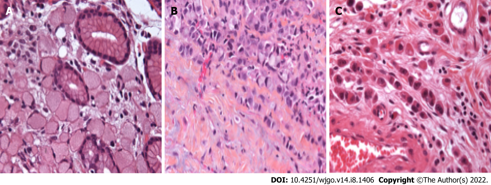 A case of primary ovarian signet-ring cell carcinoma treated with S-1/CDDP  therapy | Journal of Ovarian Research | Full Text