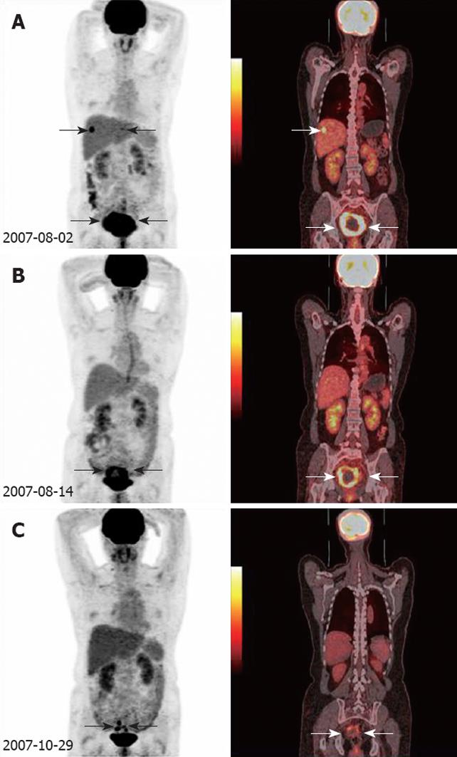 pet scan colon cancer