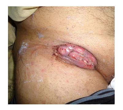 Marjolin’s ulcers in the post-burned lesions and scars
