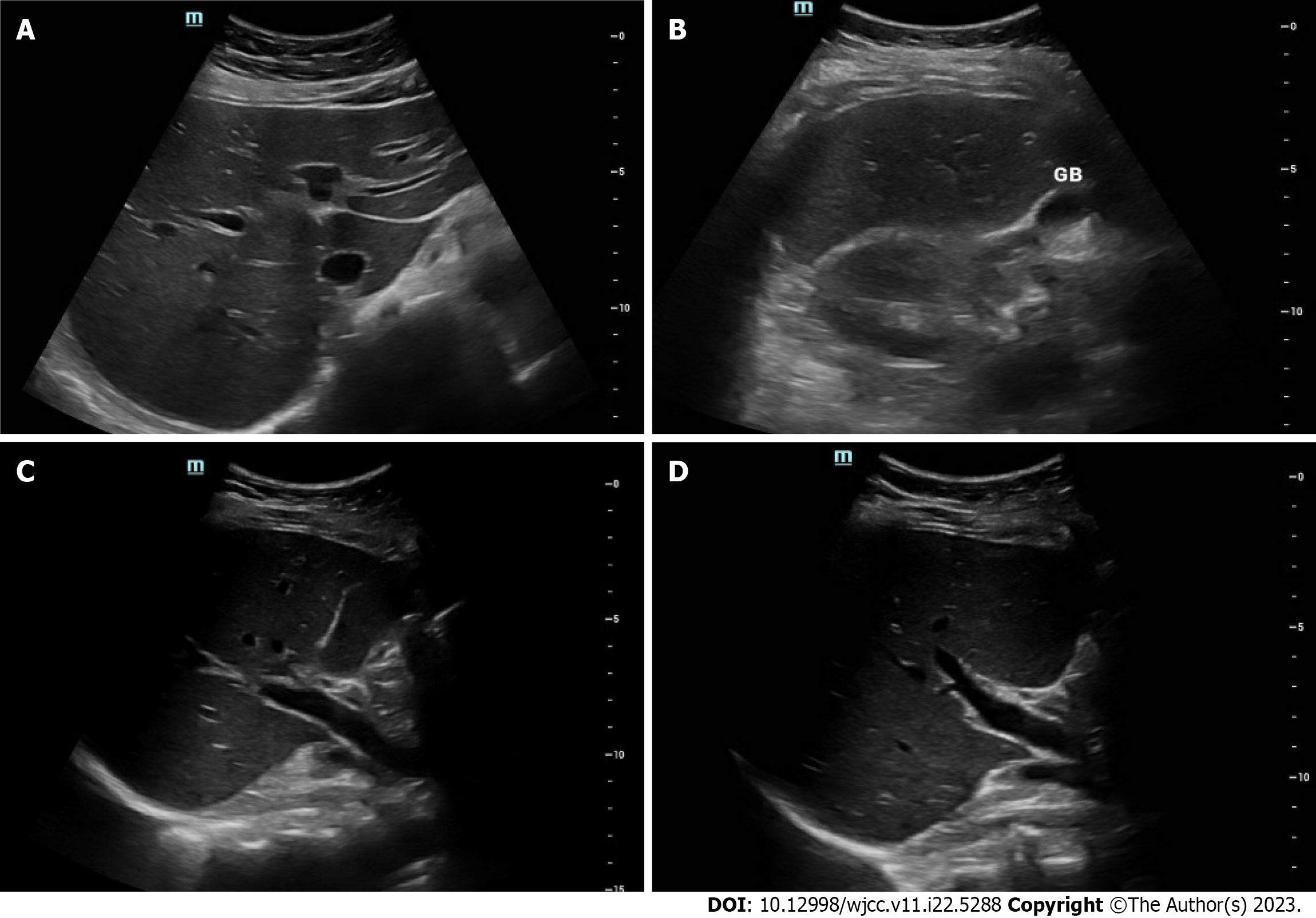 Acute hepatitis of unknown etiology in an adult female: A case report