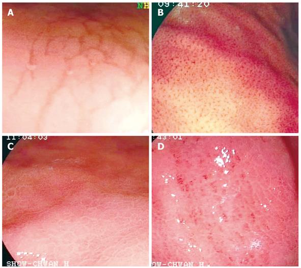 Mucosal Patterns Of Helicobacter Pylori related Gastritis Without 