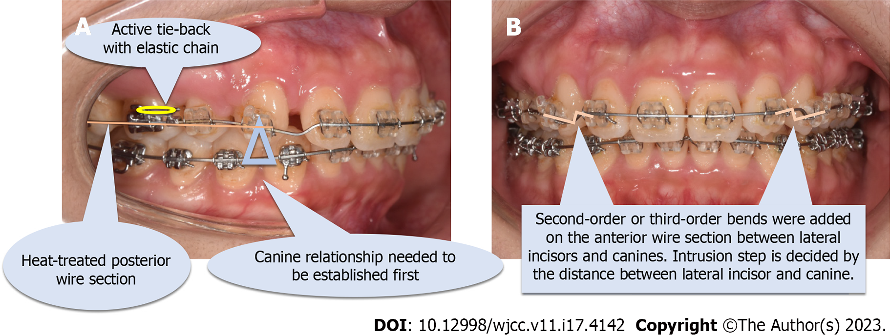 What does a reverse curve wire do for braces? 1 Month Check Up
