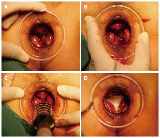 hemorrhoid skin tag