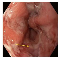 Atypical Manifestation Of Herpes Esophagitis In An Immunocompetent Patient Case Report And Literature Review