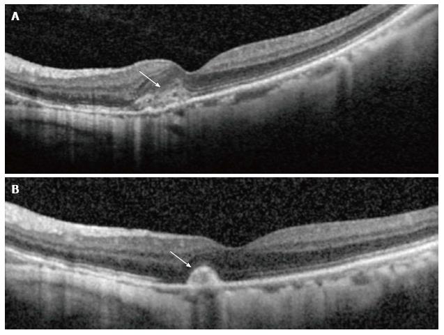 Neovascularization Of The Disc