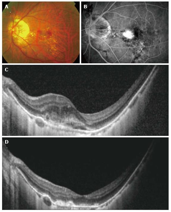 choroidal neovascular membrane oct