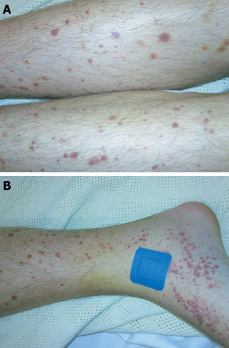 Humira Side Effects Rash