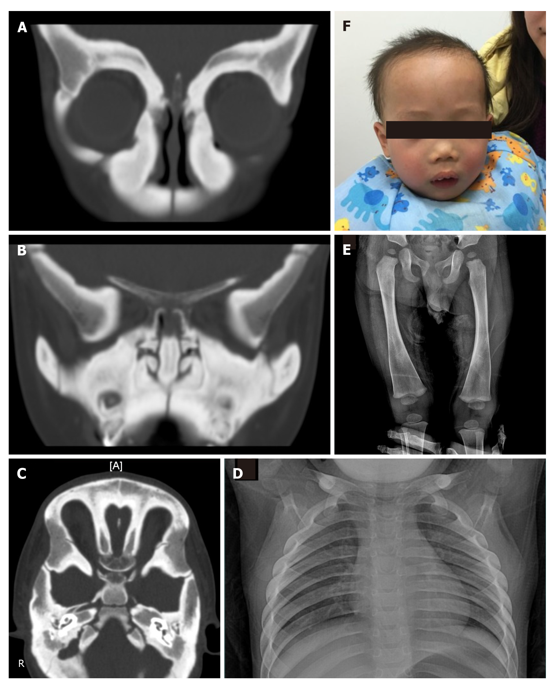 Craniometaphyseal dysplasia radiology
