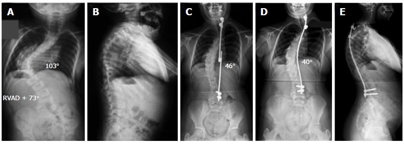 Rubinstein-Taybi syndrome with scoliosis treated with single-stage