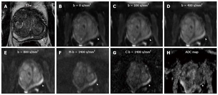 Comparison of SI with b value of 1000 s/mm2 in malignant and benign