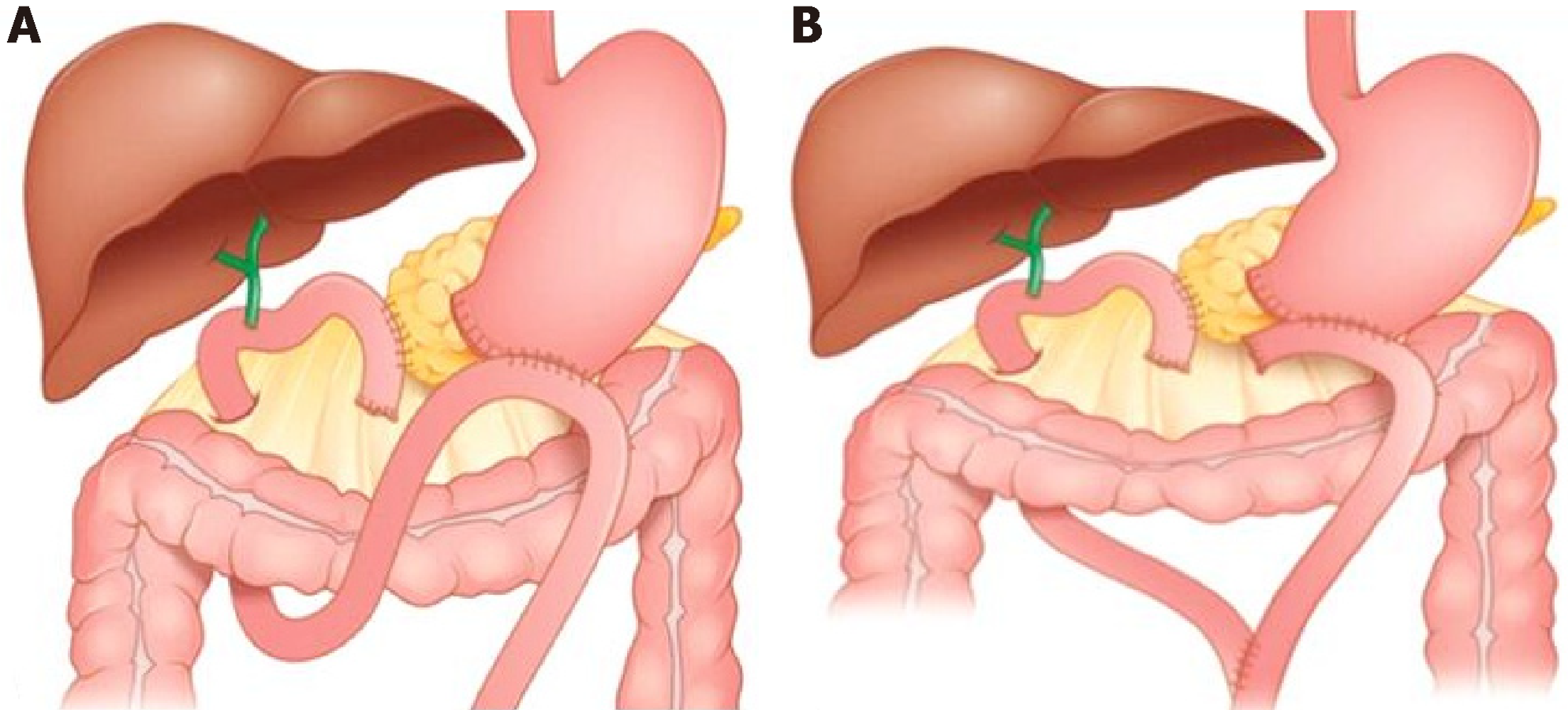 Dual Loop Roux En Y Reconstruction With Isolated Gastric Limb Reduces 