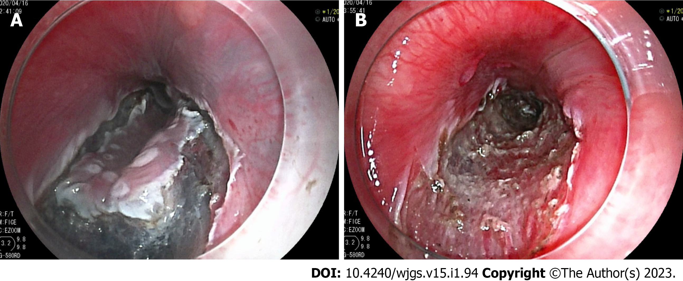 A) Anterior view of huge ulcerated mass at right breast with 32 weeks