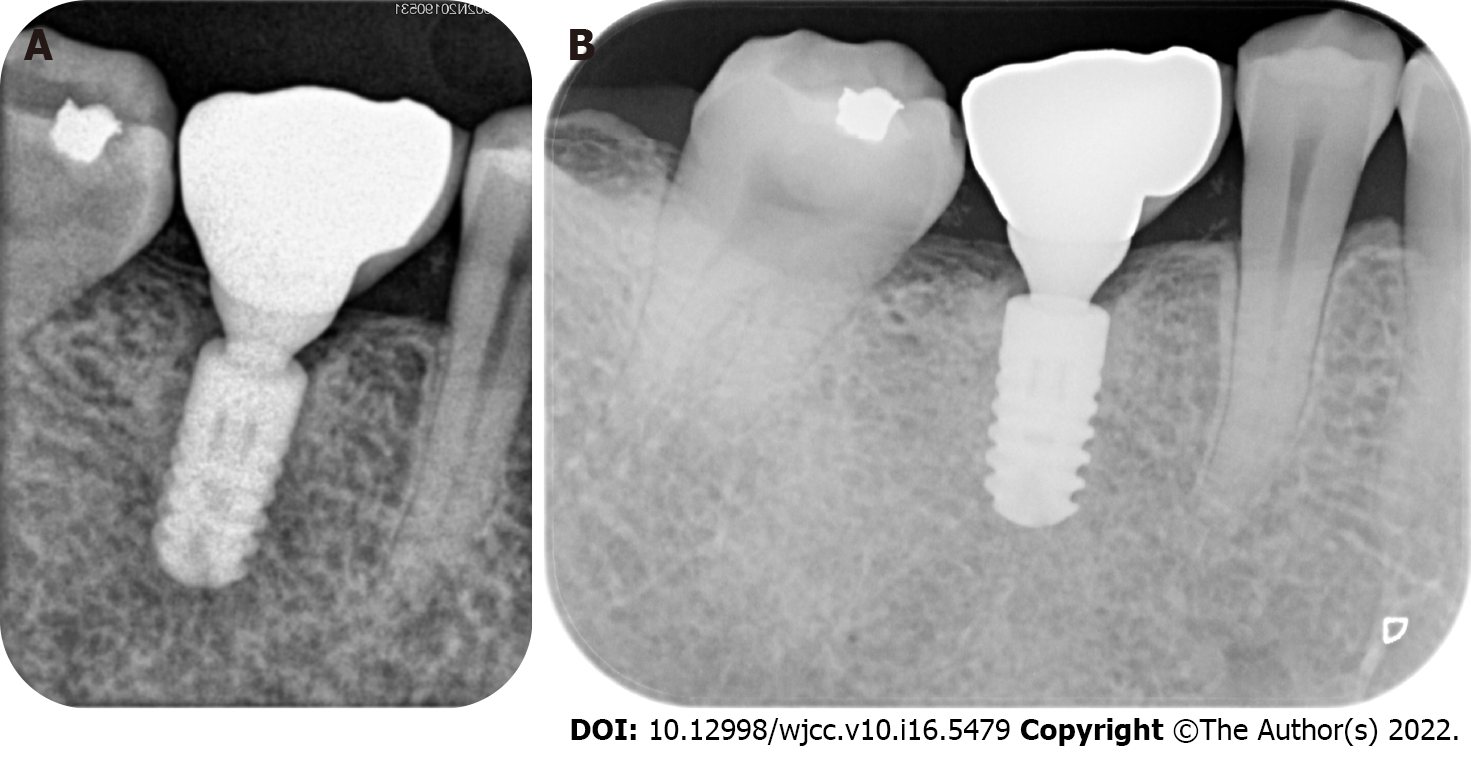 Effectiveness of the bone ring technique and simultaneous implant placement  for vertical ridge augmentation: a systematic review | International  Journal of Implant Dentistry | Full Text