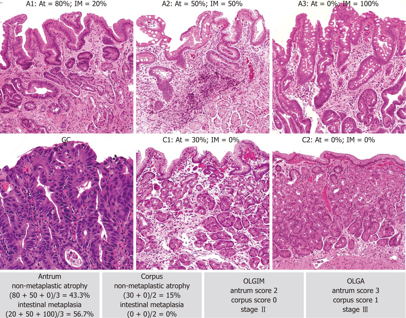 Gastritis erosiva antral dieta