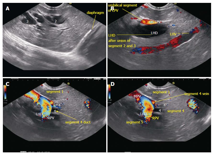 normal common bile duct ultrasound