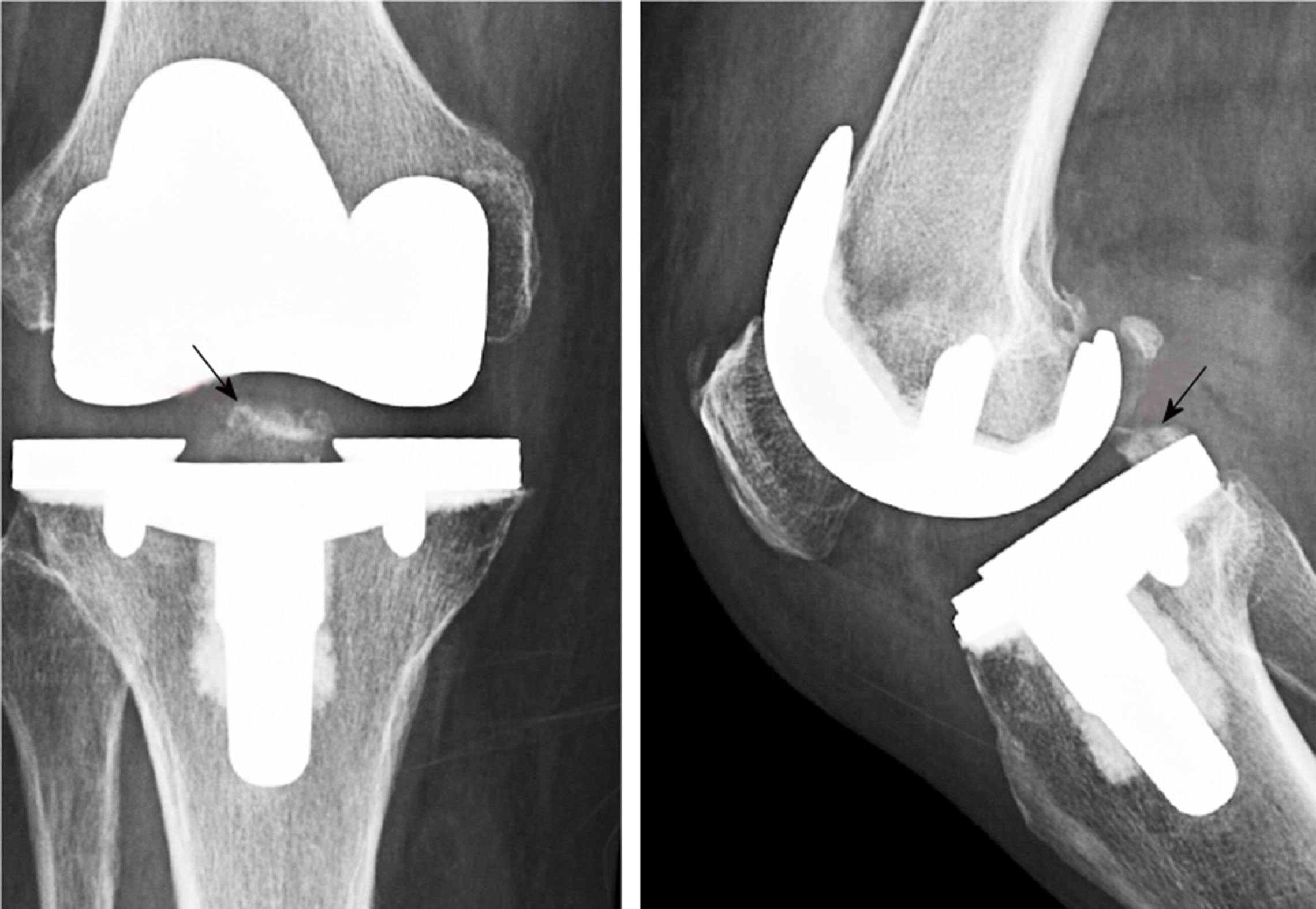Intact Pie Crusting And Repairing The Posterior Cruciate Ligament In
