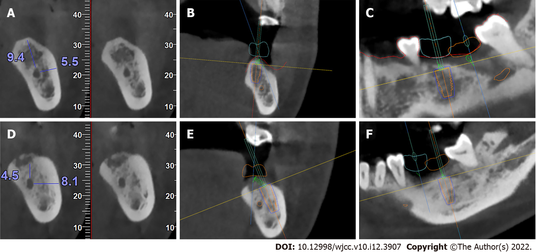 Inferior alveolar nerve, Radiology Reference Article