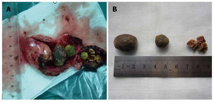 Detection Of Gallbladder Stones By Dual Energy Spectral Computed Tomography Imaging