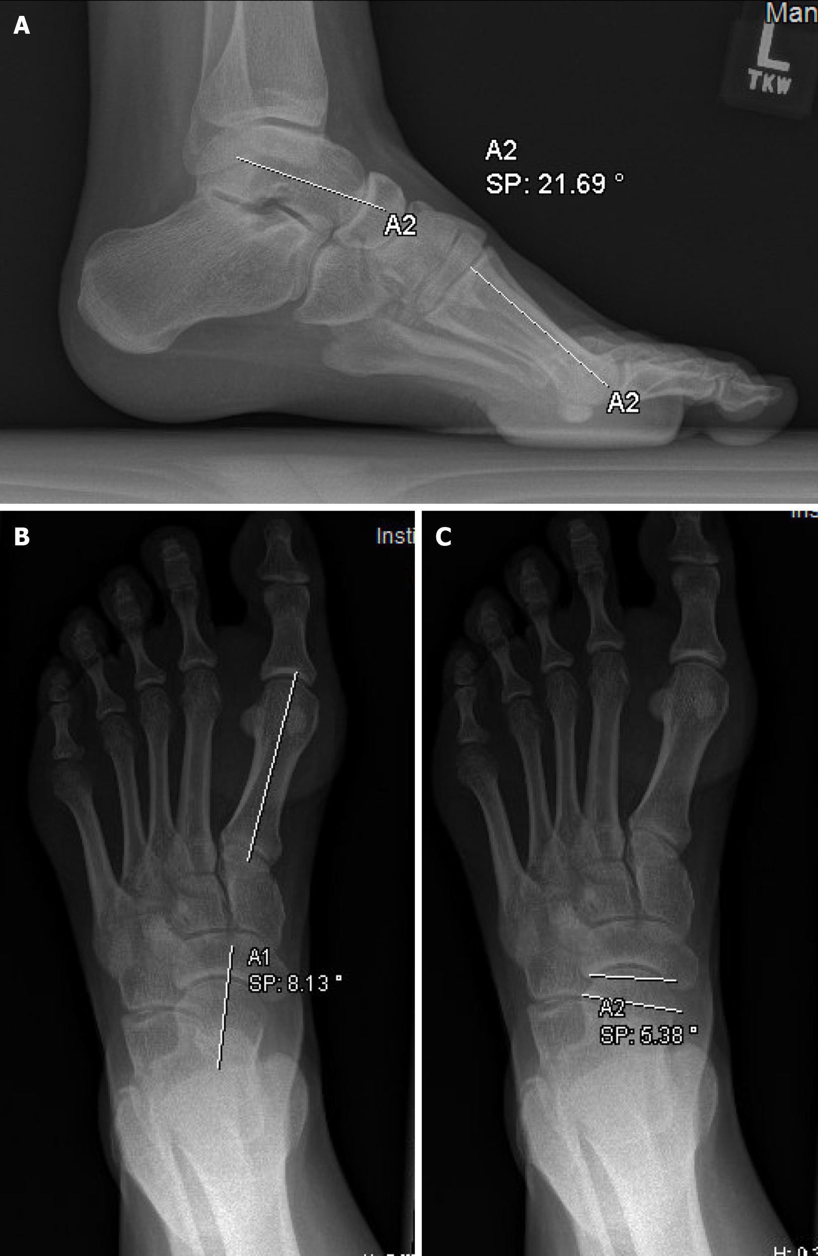 Two-stage corrective operation for the treatment of pes cavovarus in ...