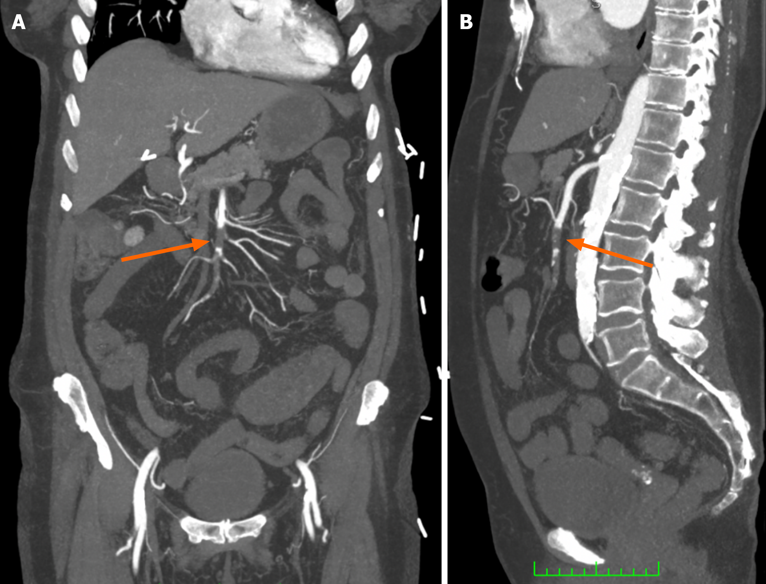 Endovascular management of acute and chronic arterial mesenteric ...