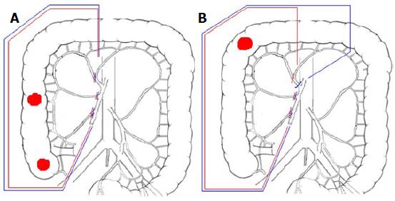 Laparoscopic complete mesocolic excision with central vascular ligation ...