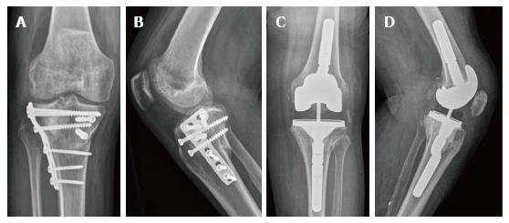 Total Knee Arthroplasty And Fractures Of The Tibial Plateau