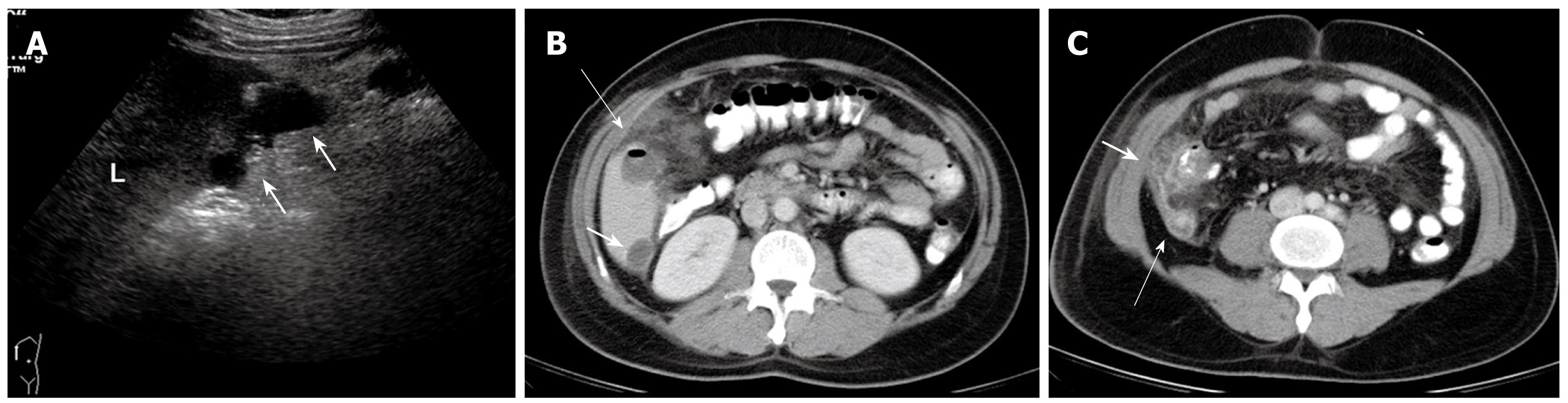 Ascending Retrocecal Appendicitis Presenting With Right Upper Abdominal