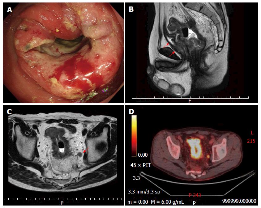 rectal tumor