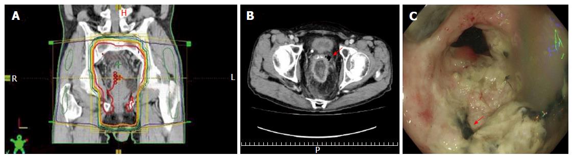 Cancer researchers first in Texas to use new prostate rectal spacer to  minimize side effects of SABR radiation treatments: September 2015 News  Releases - UT Southwestern, Dallas, TX