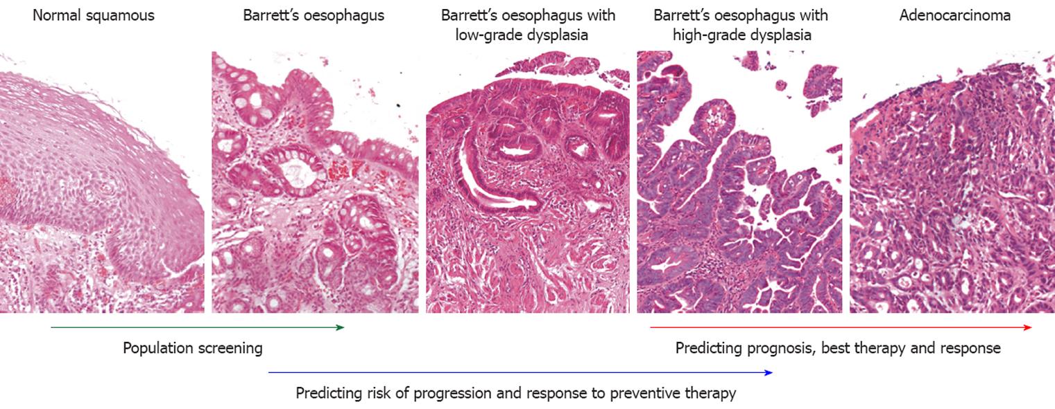 barretts esophagus histology