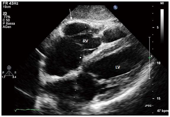 Arrhythmogenic Right Ventricular Cardiomyopathy (ARVC), 47% OFF