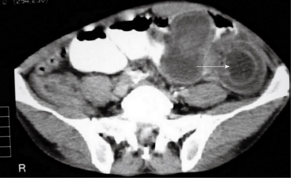 Intussusception In Adults Clinical Characteristics Diagnosis And Operative Strategies