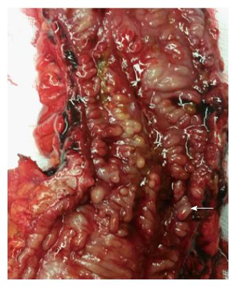 Abdominal Surgery for Crohn's disease