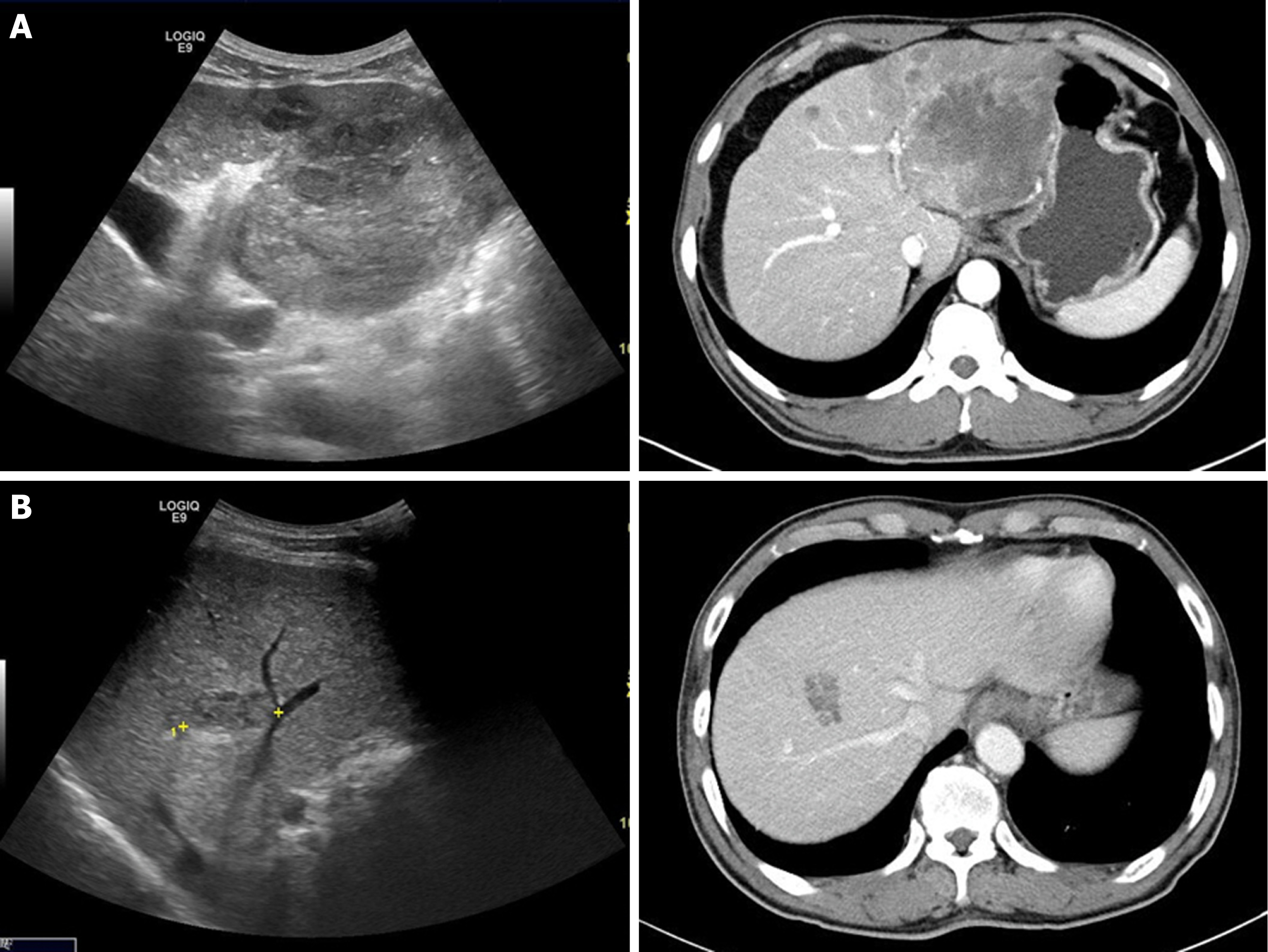 Ultrasonography Of Liver Tumors Wikipedia