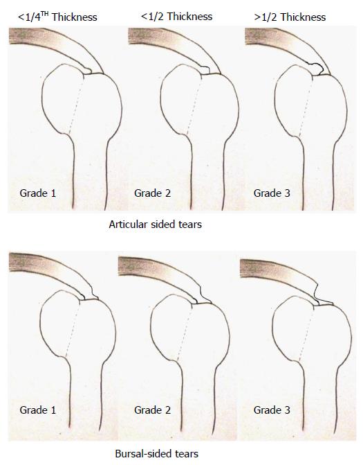 types of rotator cuff tears Cheaper Than Retail Price> Buy Clothing,  Accessories and lifestyle products for women & men 