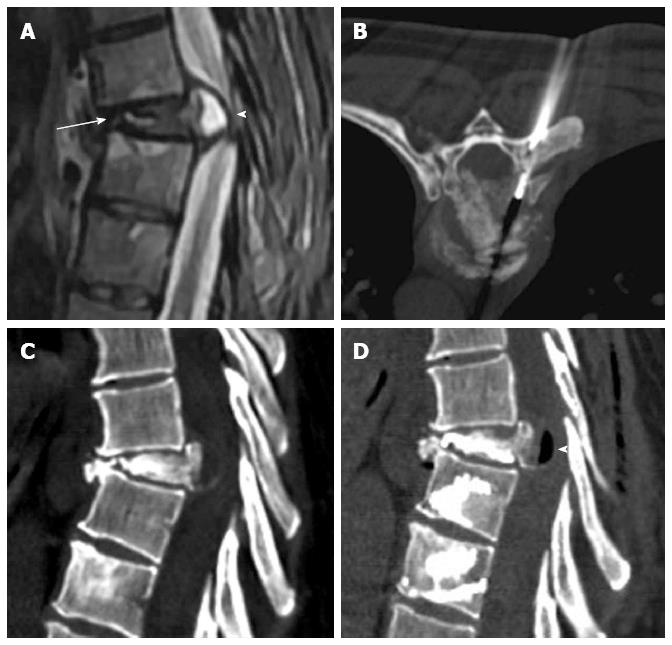 Comparative review of vertebroplasty and kyphoplasty