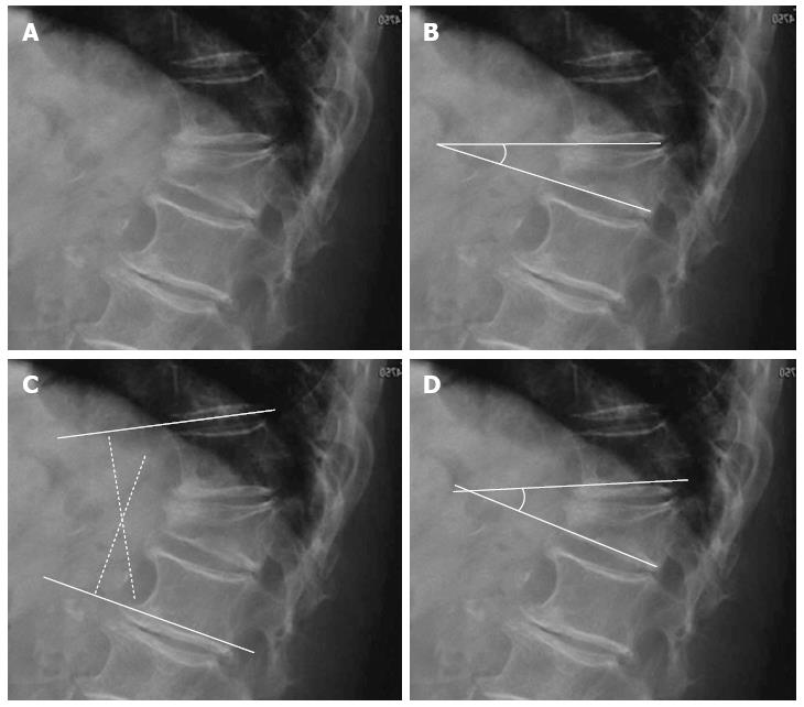 Comparative review of vertebroplasty and kyphoplasty